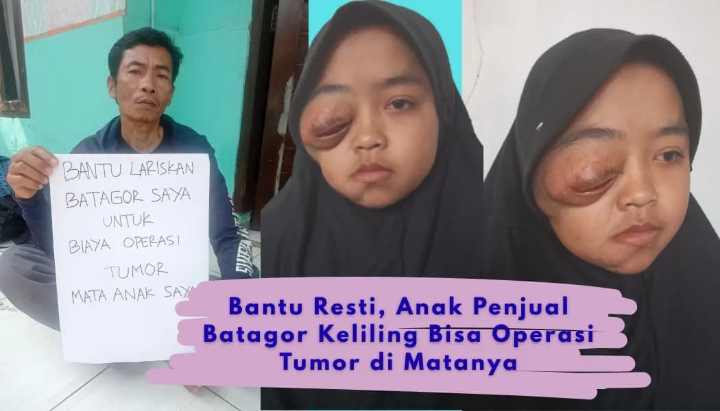 Foto campaign Bantu Anak Penjual Batagor Keliling Sembuh dari Tumor Mata