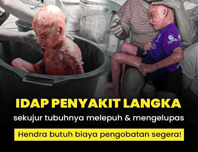 Foto campaign Idap Sakit Kulit Langkah, Nyawa Hendra Terancam