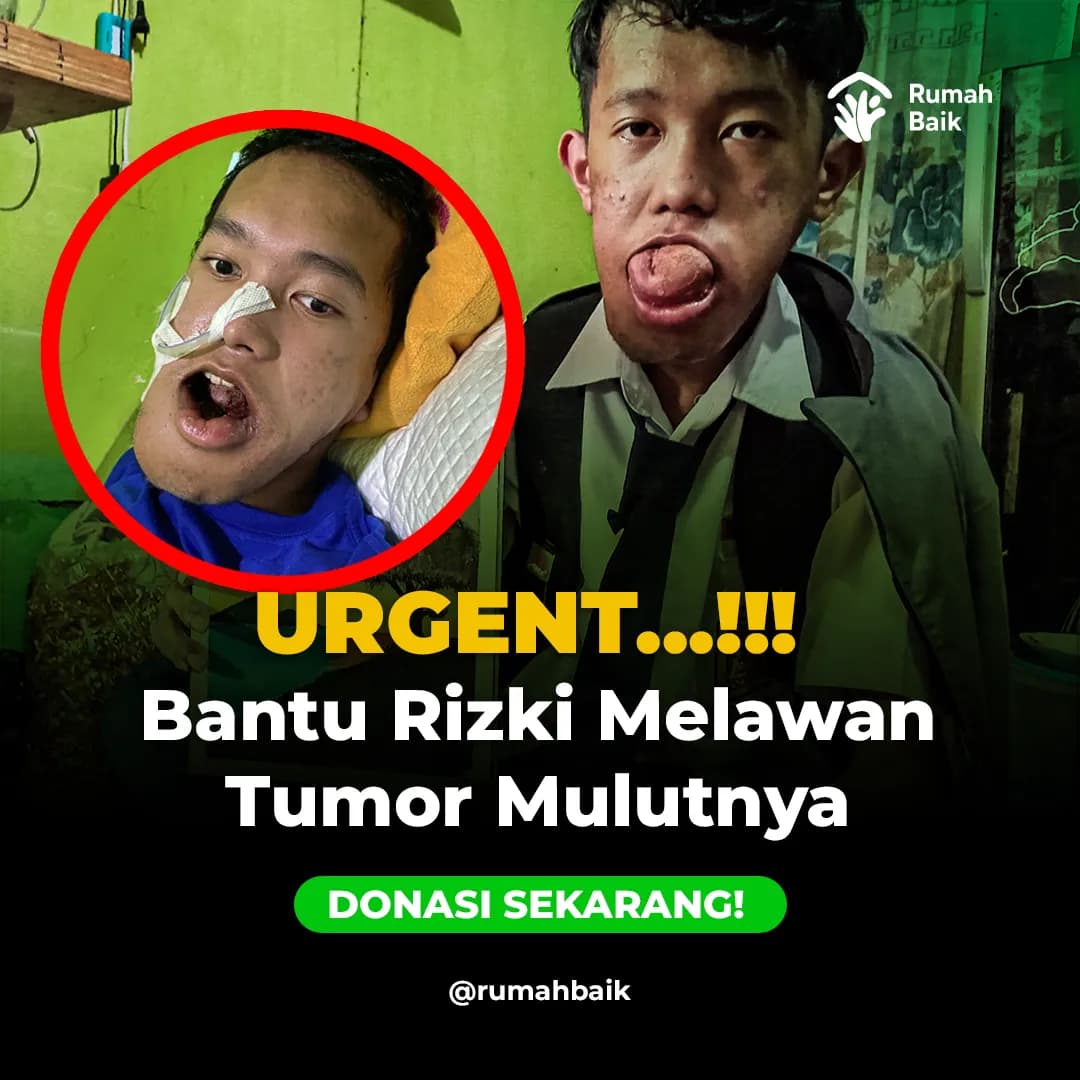 Foto campaign Anak Kuli Bangunan Ini Idap Tumor Mulut Sampai Kesulitan Berbicara