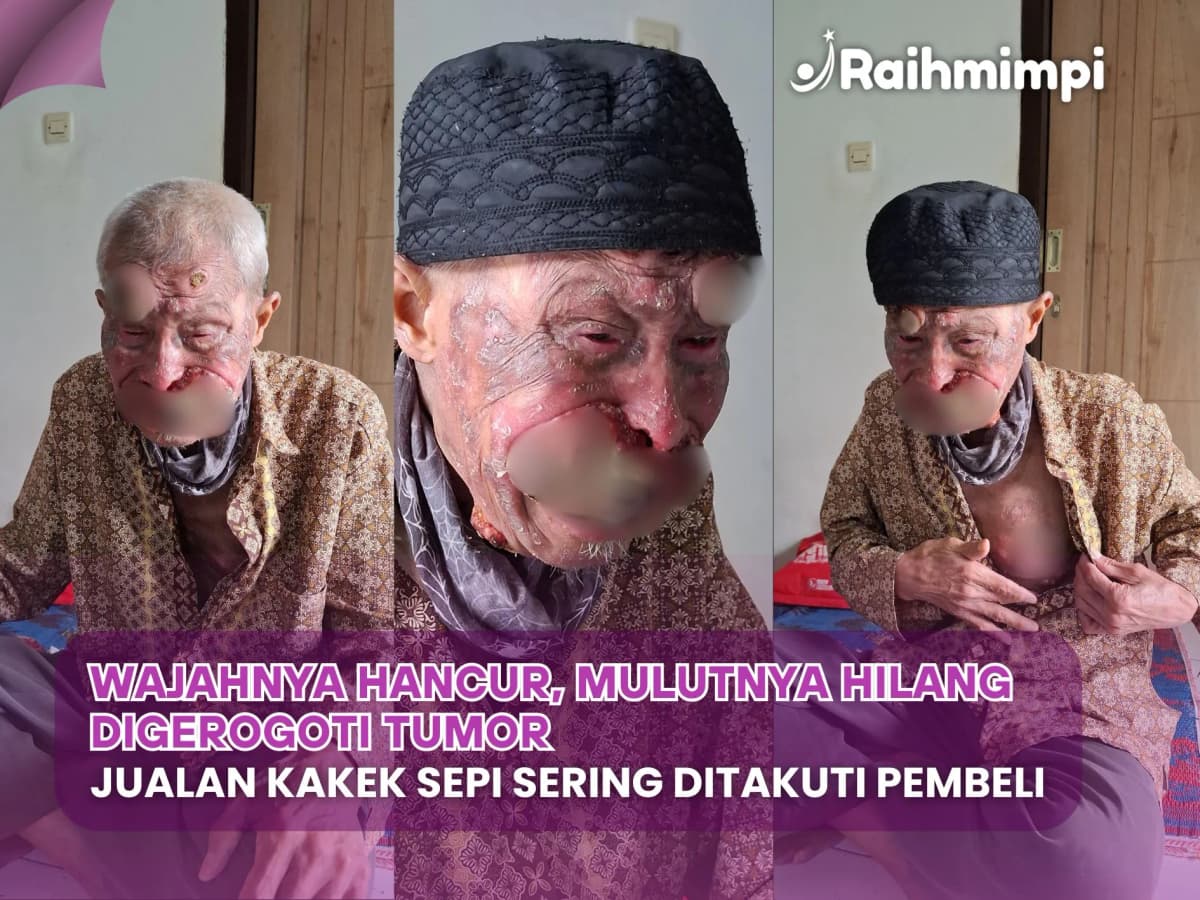 Foto campaign Wajah Hancur Digerogoti Tumor, Bantu Kakek Bisa Berobat