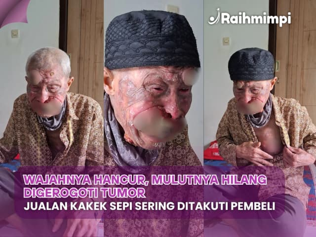Wajah Hancur Digerogoti Tumor, Bantu Kakek Bisa Berobat