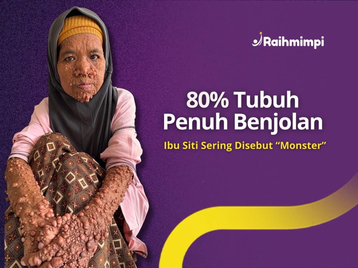 Foto campaign 80 Persen Tubuh Penuh Benjolan, Siti Dijauhi