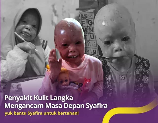 TOLONG! Penyakit Kulit Langka Mengancam Masa Depan Syafira