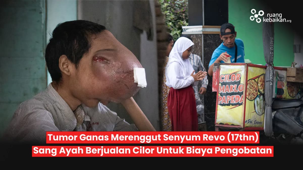 Foto campaign Bantu Revo Sembuh Wajah membengkak karena Tumor Ganas