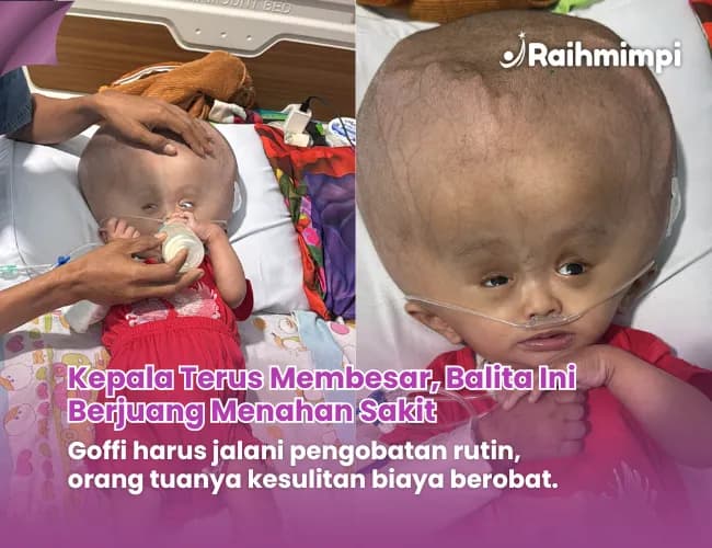 Foto campaign Kepalanya Membesar dan Kaku Tolong Anak Penjual Tisu