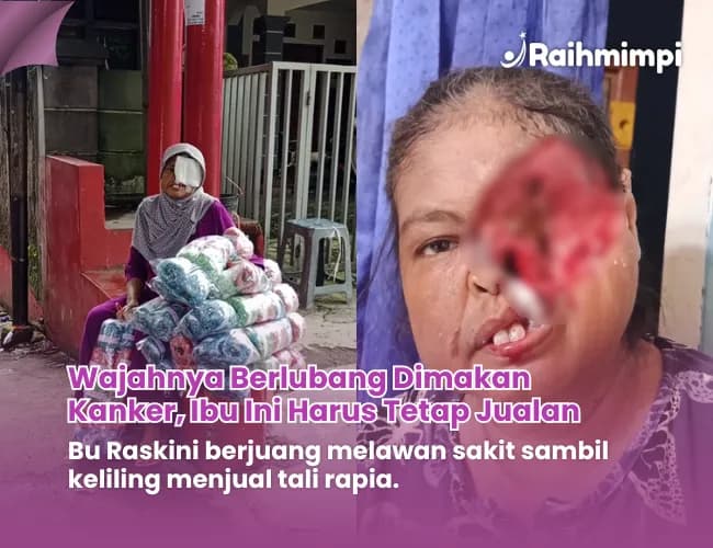 Foto campaign Tolong Wajah Ibu Penjual Tali Rapia Hancur Digerogoti Kanker