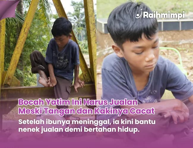 Foto campaign Tangan Kaki Tak Sempurna, Bantu Zildan Bertahan