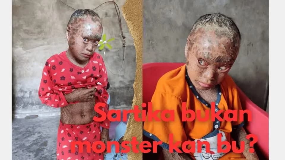 Foto campaign 16 tahun idap sakit langka kulit sartika kering dan retak