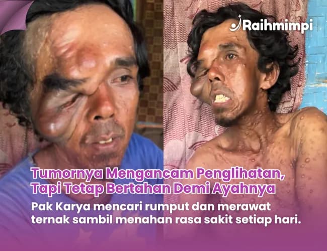 Foto campaign Wajahnya Dipenuhi Tumor Pak Karya Butuh Bantuan untuk Berobat