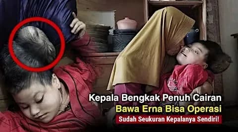 Foto campaign Bantu Dede Erna Idap Benjolan dikepala