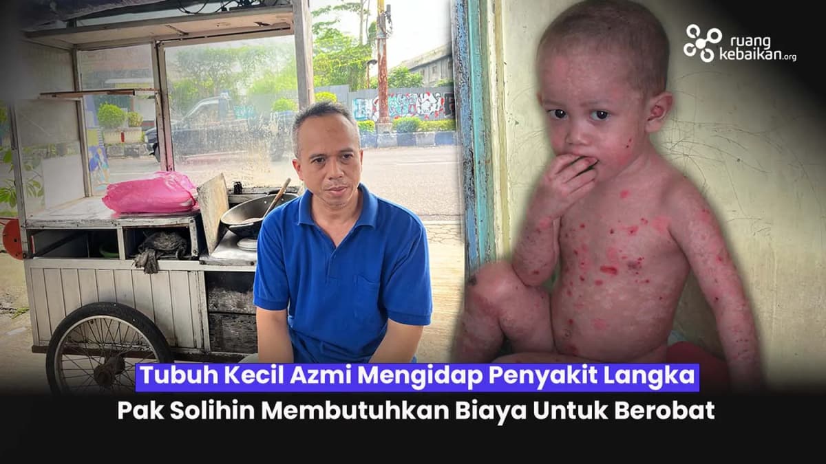 Foto campaign Digerogoti Penyakit Langka! Azmi Bocah 2 Tahun Kulitnya Melepuh