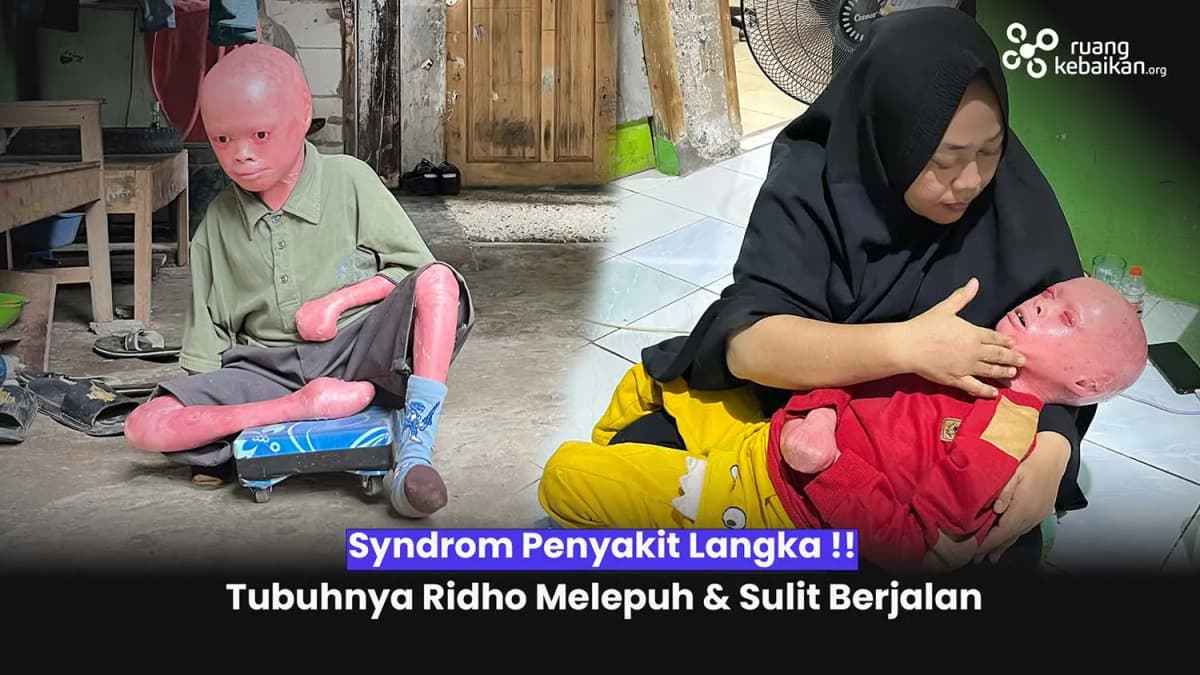 Foto campaign Syndrom Langka! Tubuh Ridho Selalu Kering dan Mengelupas