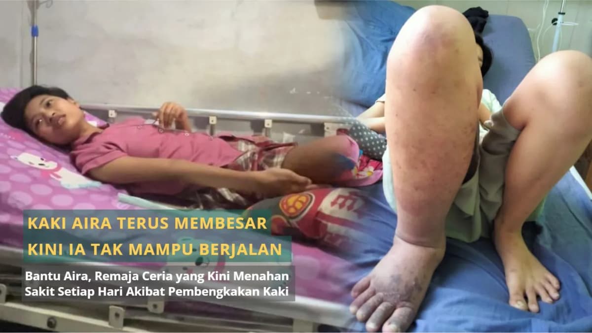 Foto campaign Kaki Aira Terus Membesar. Kini Ia Tak Mampu Berjalan