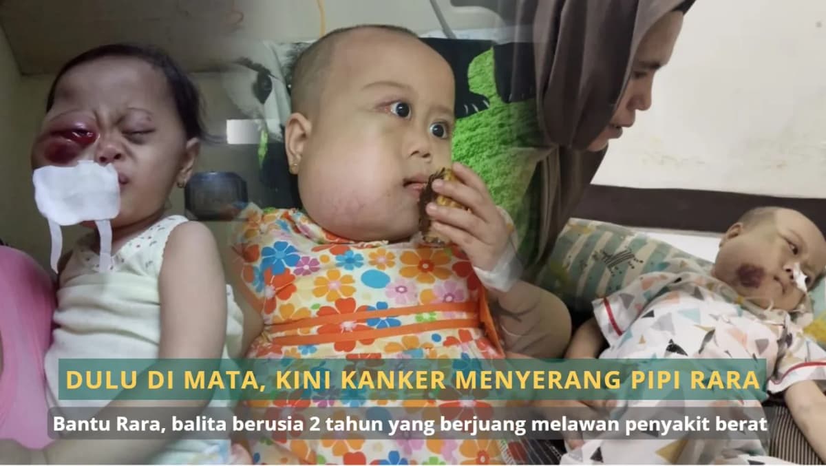 Foto campaign Dulu di Mata. Kini Kanker Menyerang Pipi Rara