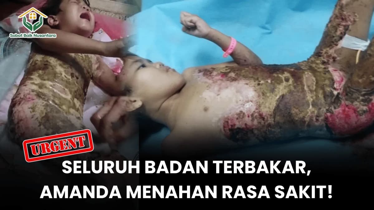Foto campaign Seluruh Badan Terbakar Amanda menahan Rasa Sakit