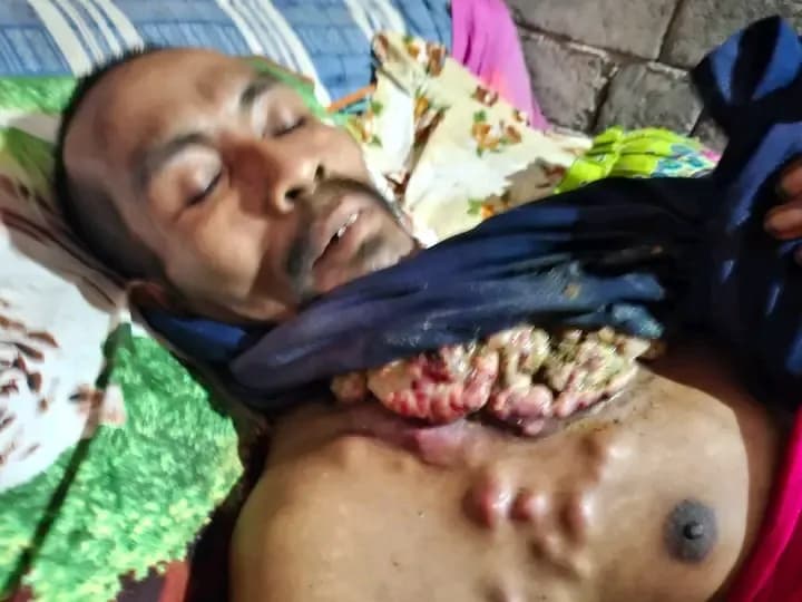 Foto campaign Ringankan Perjuangan Pak Nur Melawan Tumor Ganas