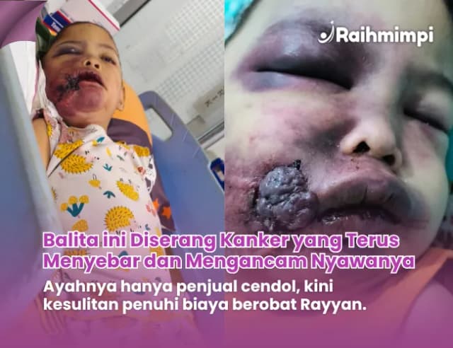 Rayyan anak penjual cendol Berjuang lawan Hemangioma