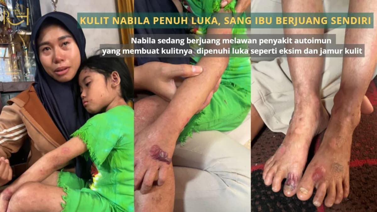 Foto campaign Kulit Nabila Penuh Luka Sang Ibu Berjuang Sendiri