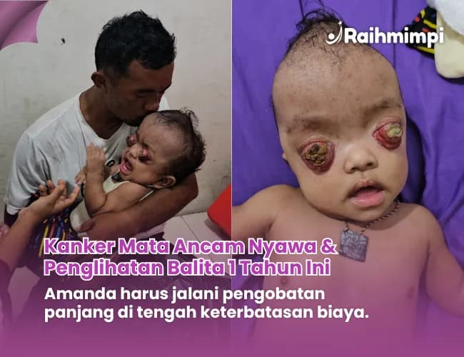 Foto campaign Bantu Amanda Melawan Kanker Mata di Usia 1 Tahun