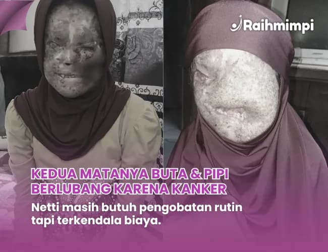 Foto campaign Selamatkan Netti dari Derita Kanker yang Semakin Parah
