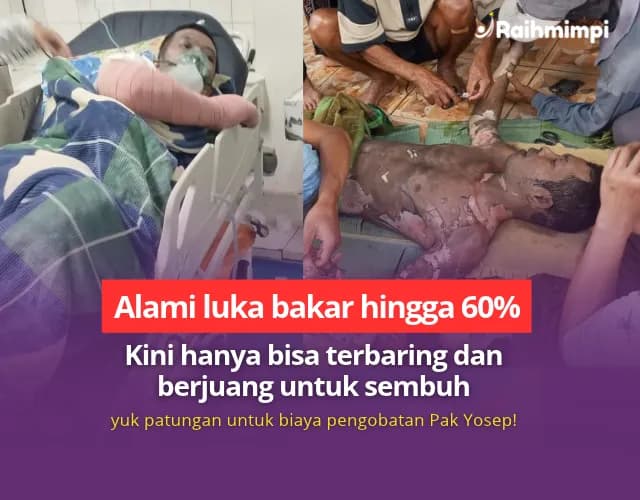 Foto campaign Seluruh Badannya Terbakar Ketika Berjuang Mencari Nafkah