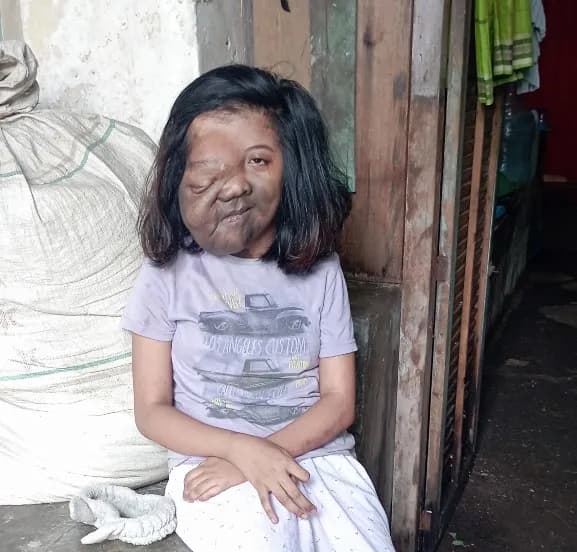 Foto campaign Diejek Mirip Monster, Bantu Perjuangan Norma Sembuh