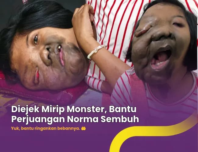 Foto campaign Diejek Mirip Monster, Bantu Perjuangan Norma Sembuh