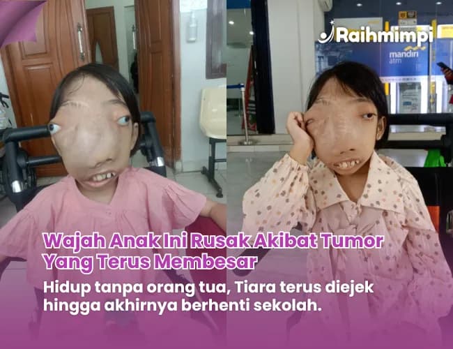 Bantu Ukir Senyuman Para Pejuang Sembuh