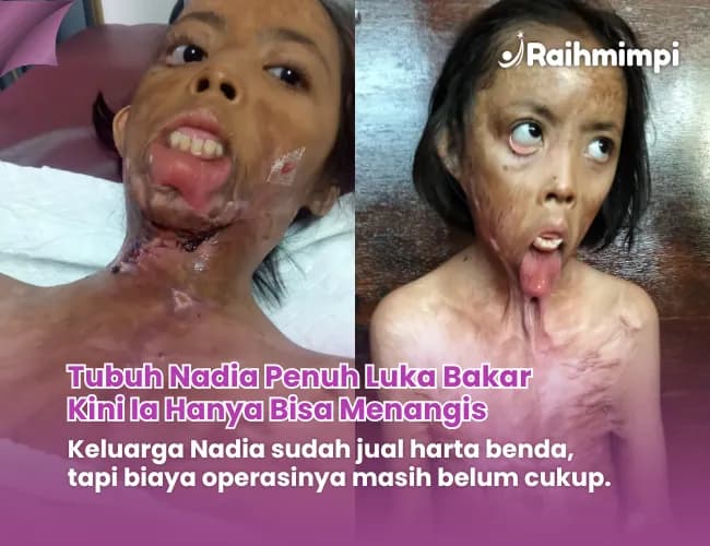 Foto campaign Peluk Harapan Pejuang Penyakit Kulit