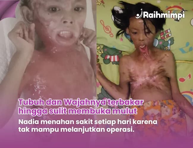 Foto campaign Peluk Harapan Pejuang Penyakit Kulit