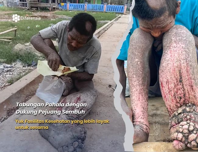 Foto campaign Ringankan Nelayan Ikhlas Sembuhkan Ponakan Kaki Gajah dan ODDJ