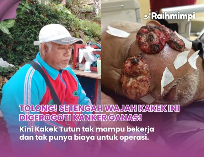 Foto campaign Urgent Setengah Wajah Pak Tutun Rusak Digerogoti Kanker
