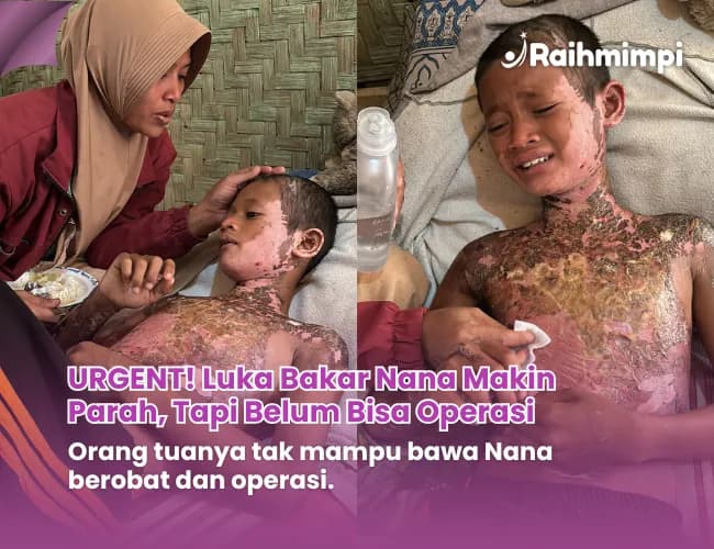 Foto campaign Urgent Tubuh Luka Bakar Bantu Nana Segera Operasi
