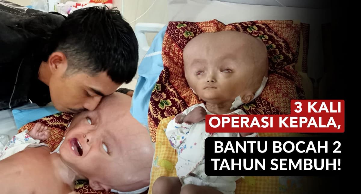 Foto campaign 3 Kali Operasi Kepala Bantu Bocah 2 Tahun Sembuh