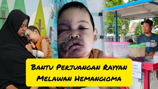 Rayyan anak penjual cendol Berjuang lawan Hemangioma
