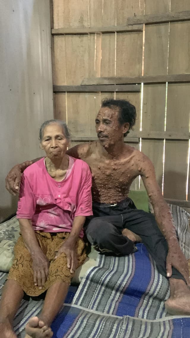 Ratusan benjolan Pak karminto rawat ibu dan bertahan hidup seadanya