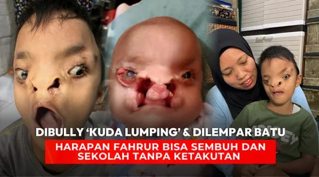 Sering Dibully Fahrur Butuh Kita untuk Melanjutkan Pengobatannya