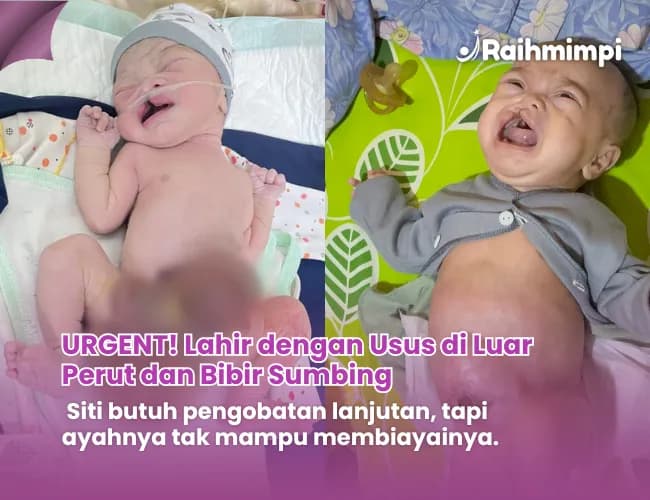 Foto campaign Usus diluar perut dan Bibir Sumbing Bantu Bayi Siti sembuh