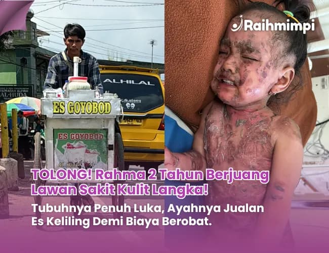 Foto campaign Sekujur Tubuh Melepuh Berdarah dan Membusuk Bantu dik Rahma Berobat