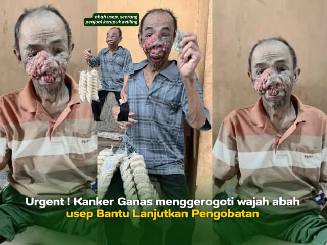 Kanker Ganas menggerogoti wajah abah usep Bantu Lanjutkan Pengobatan