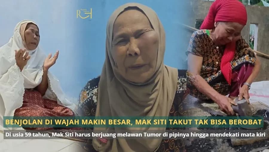 Foto campaign Benjolan Di Wajah Semakin Membesar Mak Siti Takut Tak Bisa Berobat