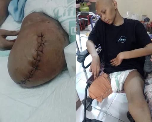 Evan, Remaja Aktif yang Melawan Kanker Tulang