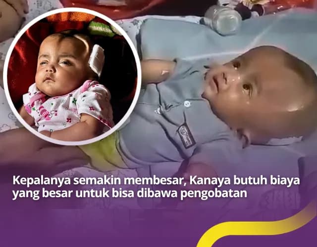 Bantu Kanaya Berjuang Untuk Sembuh Dari Hidrosefalus