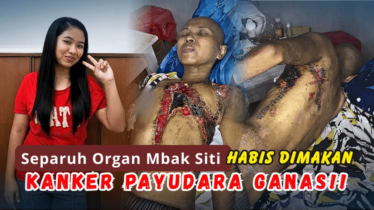 Foto campaign KANKER PAYUDARA GANAS MENGGEROGOTI DADA MBAK SITI, 6 KALI KEMOTERAPI HARUS IA JALANI