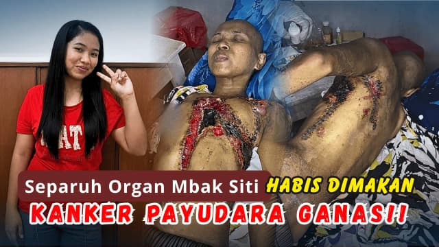 KANKER PAYUDARA GANAS MENGGEROGOTI DADA MBAK SITI, 6 KALI KEMOTERAPI HARUS IA JALANI
