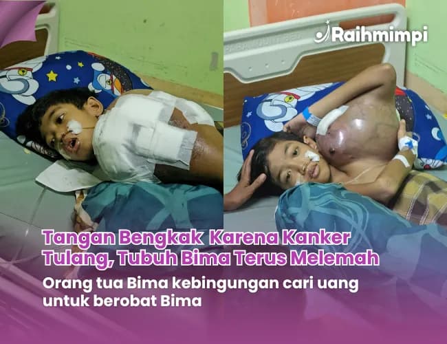 Foto campaign Terancam kehilangan tangan bantu bima berjuang lawan kanker tulang