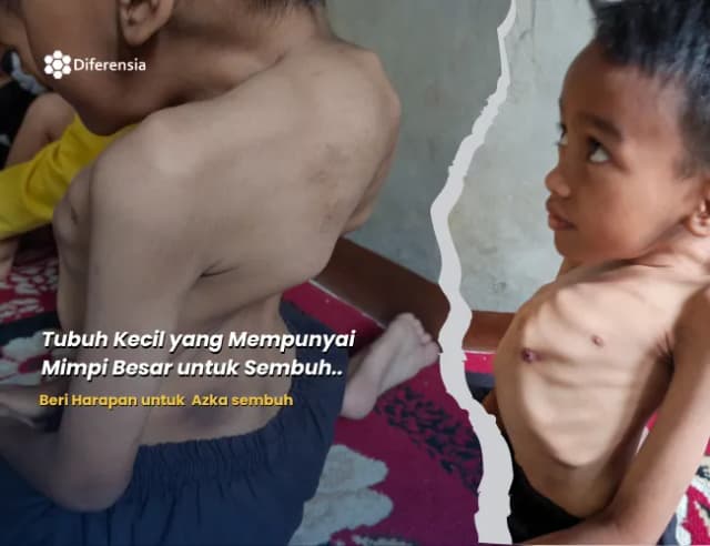 Dukungan untuk Azka. Anak dengan Kelainan Tulang Belakang
