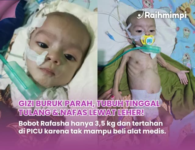 Bantu Bayi Kecil Ini Terbebas Dari Gizi Buruk dan Infeksi Paru Akut