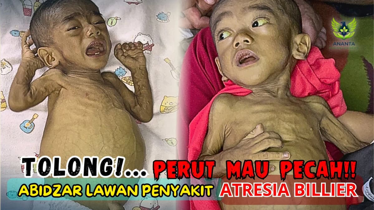 Foto campaign Tolong Perut Mau Pecah, Abidzar Lawan Penyakit Attresia Billier
