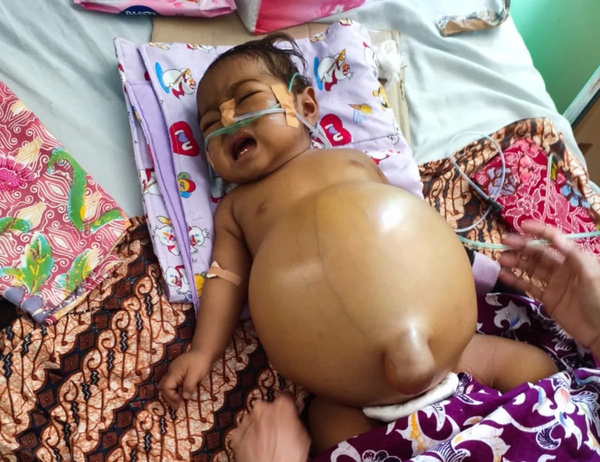 Foto campaign DARURAT! Bantu Zamira Bayi 11 Bulan yang Mengalami Pembengkakan Perut
